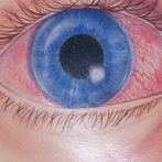 Loss of Sight…